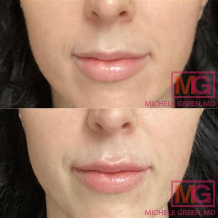 Megan Rapinoe Plastic Surgery | Botox And Lip Filler Photos Before And After